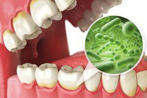 Dental Implants Aliso Viejo and Gum Disease