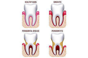 Gum Disease Treatment Aliso Viejo Identifies the Symptoms