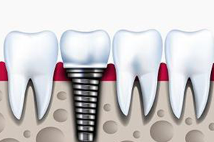 Dental Implants Laguna Hills CA