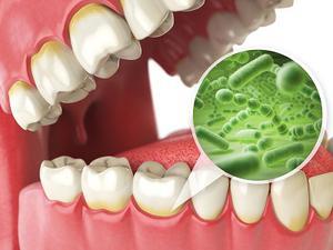 Dental Implants Laguna Hills CA - Gum Disease