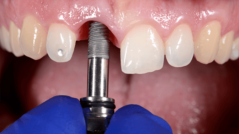Dental Implants Aliso Viejo CA