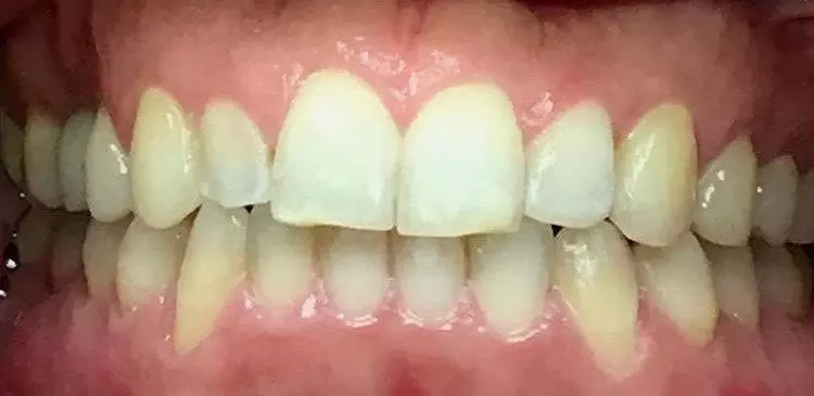case1-invisalign-a
